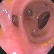 diverticulosis diseases colorectal